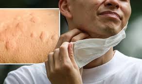 Graves' disease is an autoimmune disease that leads to a generalized overactivity of the entire thyroid gland (hyperthyroidism). Coronavirus New Strain Symptoms Rashes Chilblains And Hives Are Signs Express Co Uk