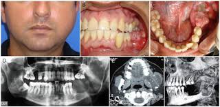 Calcifying epithelial odontogenic tumor: a case series from South America