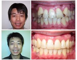 Aligners Can For Your Cants | Orthodontic Products