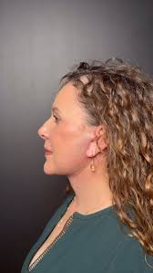 Full Facelift Deep Plane 🤩 before and after 🙌🏻