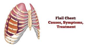 Image result for Flail Chest