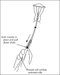 Patients who request appointments for iud insertion or removal should be scheduled as soon as possible—but no later than 7 days after residents may perform iud insertions only if a credentialed physician is present during the procedure. Insertion And Removal Of Intrauterine Devices American Family Physician