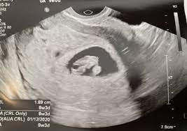 For example, you may be offered further tests that have a risk of. 8 Weeks Dating Scan December 2020 Birth Club Babycenter Australia