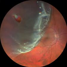 Image result for Retinal Detachment