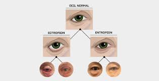 Une chirurgie de la myopie une chirurgie de l'hypermétropie , une chirurgie de la presbytie, une chirurgie de l'astigmatisme , toute chirurgie réfractive des yeux au laser nécessitent le choix d'un chirurgien ophtalmologue exercé et d'un centre moderne spécialisé en chirurgie réfractive pour. Traitement Entropion Ectropion A Paris Centre Ophtalmologique Coss