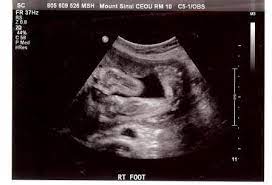 Club foot can be diagnosed by ultrasound of the fetus in more than 60% of cases. Protected Blog Log In Club Foot How To Apologize Ultrasound