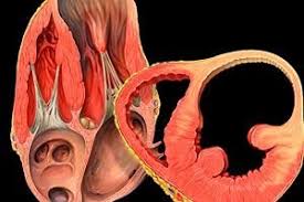 Aorta, que é a principal artéria do coração (aneurisma da aorta abdominal ou aneurisma da aorta torácica). Aneurisma Do Coracao O Que E E Os Sintomas Competentemente Sobre Saude No Ilive