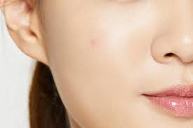 Feil omsorg for barnet, overflødig fuktighet på huden. Cosrx Acne Pimple Master Patch Skinsecret No