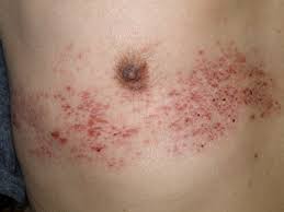 Definition of 帯状疱疹, meaning of 帯状疱疹 in japanese: ç—›ã¿ã®ã‚ã‚‹æ¹¿ç–¹ å¸¯çŠ¶ç–±ç–¹ Herpes Zoster åºƒå³¶çœŒå'‰å¸‚ æ©‹æœ¬ã‚¯ãƒªãƒ‹ãƒƒã‚¯ æ©‹æœ¬ã‚¯ãƒªãƒ‹ãƒƒã‚¯ ã‚†ã‚ã‚¿ã‚¦ãƒ³å'‰ å'‰å¸‚ çš®è†šç§'