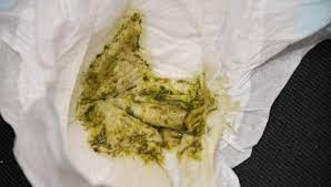 Das Baby Hat Einen Grunlichen Stuhl Mit Schleim Ursachen Von Schleim Im Stuhl Eines Kindes Und Welche Farbe Als Normal Angesehen Wird