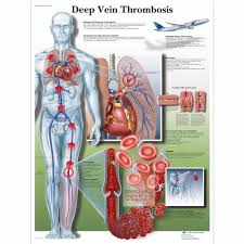 deep vein thrombosis chart