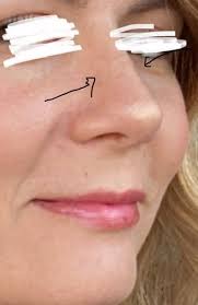 Unsuccessful rhinoplasty and revision