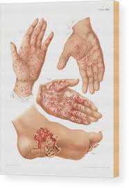 Image result for Secondary Syphilis