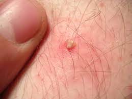 Its not a bot fly Ingrown Hair Cyst Causes Removal Prevention And Best Treatment 2020 Community Pharmacies
