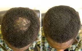 Mainly, these products are colored keratin proteins that are statically charged. A Quick Fix For Your Bald Spots Damaged Hairline Super Million Hair Bellanaija