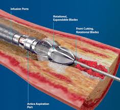 To reviews, gameplay, commentary and much, much more! Jetstream Atherectomy System Vascupedia