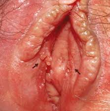 Image result for Herpes Simplex