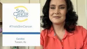 This Is Skin Cancer: Candice