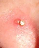 Infected Nose Piercing Causes How To Treat Clean Infected Nose Signs Pictures Nose Nose Piercing Nose Piercing Infection Facial Piercings