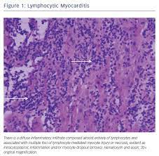 The duration of problems can vary from hours to months. Fulminant Myocarditis A Review Of The Current Literature Usc Journal