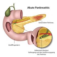 Bauchspeicheldrusenentzundung Pankreatitis Ursachen Symptome Behandlung Medlexi De