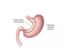 Learn how much an gastric sleeve (inpatient) costs near you. How Much Does Weight Loss Surgery Cost Without Insurance Weightlosslook