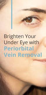 Since it is quite thin and prone to damages, it prevails to establish visible the unattractive blue veins around the eyes are referred to as periorbital veins. Brighten Your Under Eye With Periorbital Vein Removal Vein Health Clinic Melbourne