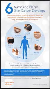 Jessica wu explains common causes of dry skin, including chapped lips and cracked hands. Skin Cancer Everyone S At Risk