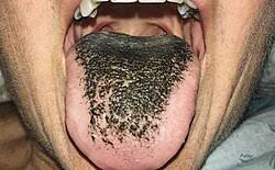 Image result for brown tongue symptoms