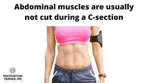 How do you know if you have diastasis recti. Diastasis Recti After A C Section What You Need To Know Postpartum Trainer Md