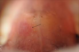 Image result for syphilis ulcer