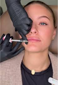 Preferred Lip Filler Injection Technique Explained