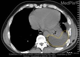 Image result for Hemothorax
