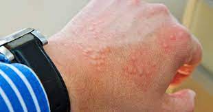 Dermatitis Por Contacto Que Es Y Que La Ocasiona Clikisalud Net Fundacion Carlos Slim