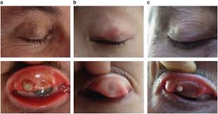 Image result for milium cyst on eyelid