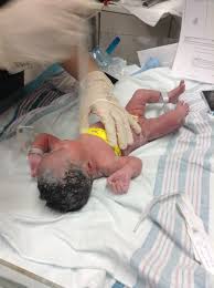 As these babies aren't fully developed, certain measures need to be taken for their survival. Birth Story 36 Weeks 1 Day March 18th Justmythawtz