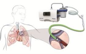 Respiratory muscle training the benefits of using. First Pulmonary Embolism Patient Treated With Cyclical Aspiration System Venous News