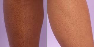 How To Get Rid Of Strawberry Legs