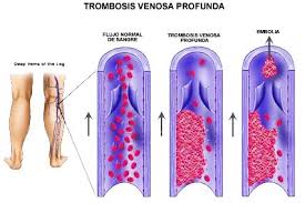 Alta tras trombosis venosa profunda. Trombosis Venosa Profunda Un Riesgo Silencioso En Flebologia