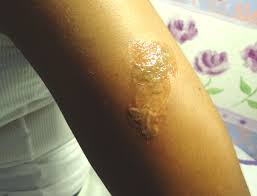 Also known as laser tattoo removal and body art removal. Laser Tattoo Removal Aftercare Guidelines Salon Innovation