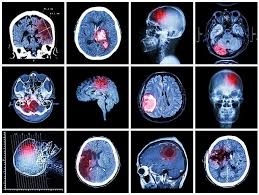 Image result for Brain Contusion