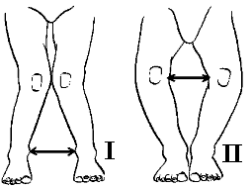 Image result for Genu Varum