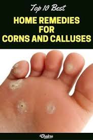 Calluses And Corns Best Home Remedies And How To Prevent It Ahy Holistic Remedies Natural Remedies Foot Remedies