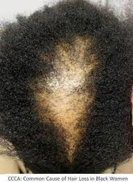 Hair Loss In Black Women Ccca Donovan Hair Clinic Black Women Hair Loss Thinning Hair Black Women Hair Loss Remedies Women