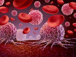 Image result for Hematologic Cancer