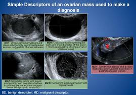 While ovarian cysts are usually asymptomatic, complications due to rupture of a cyst can occur and. Would A Regular Ultrasound Be Able To Differnciate A Benign Ovarian Cyst From An Ovarian Tumor Or Is A Transvaginal Ultrasound Needed Medical Sciences Stack Exchange