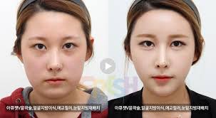 Contouring for a crooked nose if you have a crooked nose (a nose that appears uneven or slightly slanted rather than following a straight line), contour a straight line on both sides of the bridge and apply highlighter in. Accuzet V Contouring Facial Fat Grafting Aegyo Filler Eye Bag Relocation Korean Plastic Surgery Brazilian Butt Lift Fresh Plastic Surgery