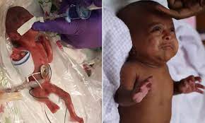 World S Smallest Surviving Premature Baby Goes Home After Five Months In The Nicu Daily Mail Online