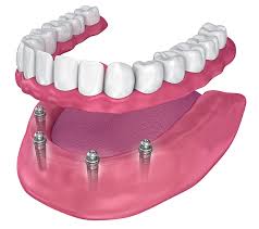 All-on-4 Implants Portland, ME | Inspire Dental of Maine | Teeth in a Day