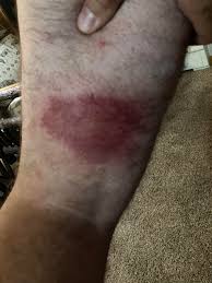 Image result for yellow sac spider bite skin